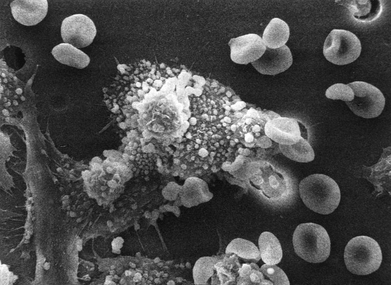 Cancercell under angrepp av immunförsvarets makrofager som injicerar gifter i cancercellen.